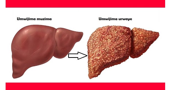 Ibimenyetso bizakwereka ko umwijima wawe urimo kwangirika