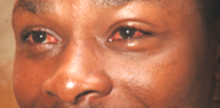 Uburwayi bw'amaso yandura bugeze muri Uganda