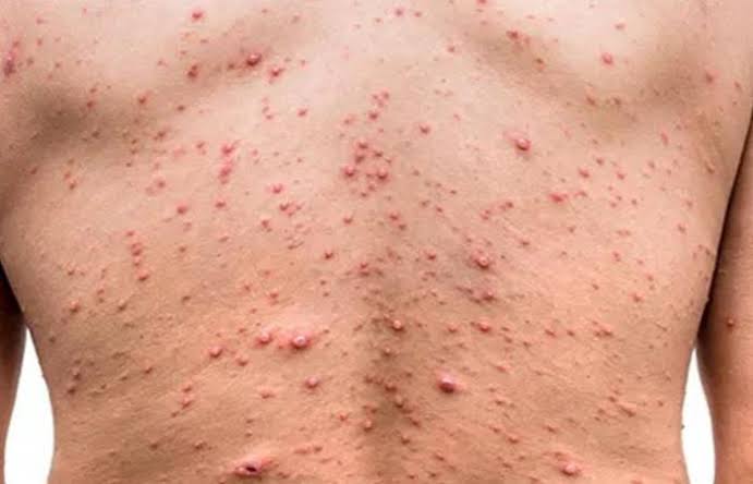 Bugesera: Abantu babiri bagaragaweho Monkeypoc