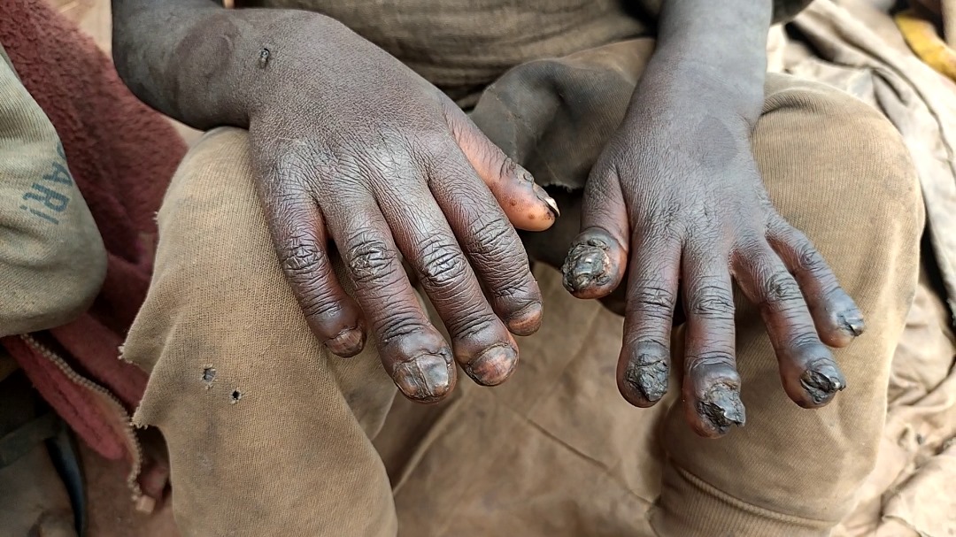 Nyaruguru: Haracyagaragara abaturage barwaye imvunja.